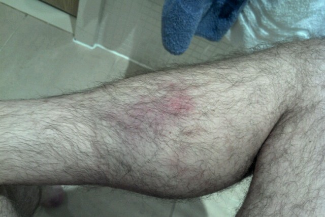 Leg Bruise