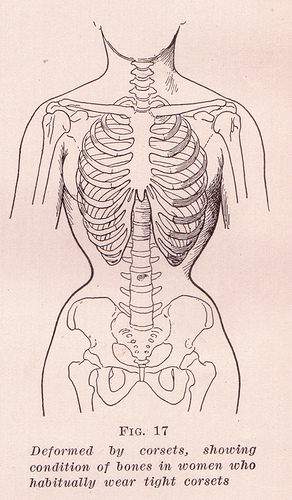an illustration of ribs constricted by a corset