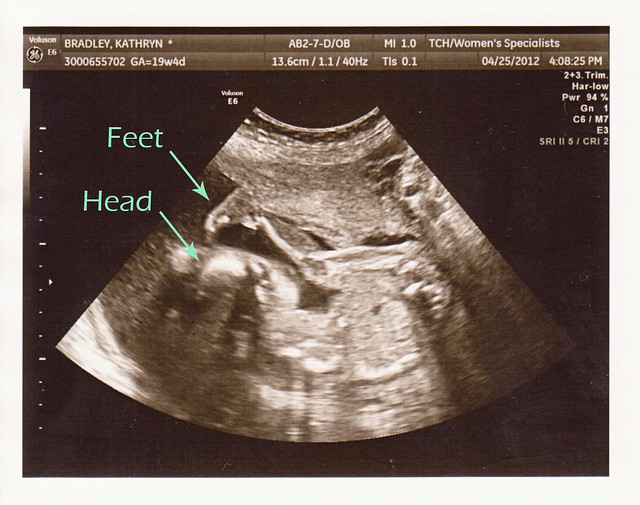 baby boy 3 at almost 20 weeks 007e