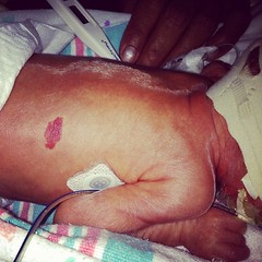 He has a birth mark! Rhys. Day 10. #preemie #twins