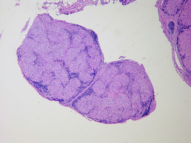 Sarcoidosis - Mediastinal lymph node biopsy Case 242 | Flickr - Photo