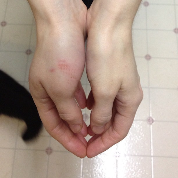 swollen hand