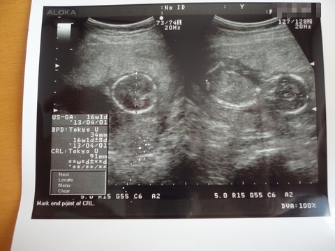 赤ちゃん エコー写真 妊娠4ヶ月 (さなさん)