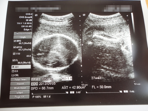 赤ちゃん エコー写真 妊娠7ヶ月 (さなさん)