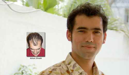 ILHT hair-transplant-results-Adnan by ilhtpaki