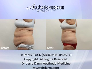Dr. Darm, Tummy Tuck Before and After - R.B. Slide3
