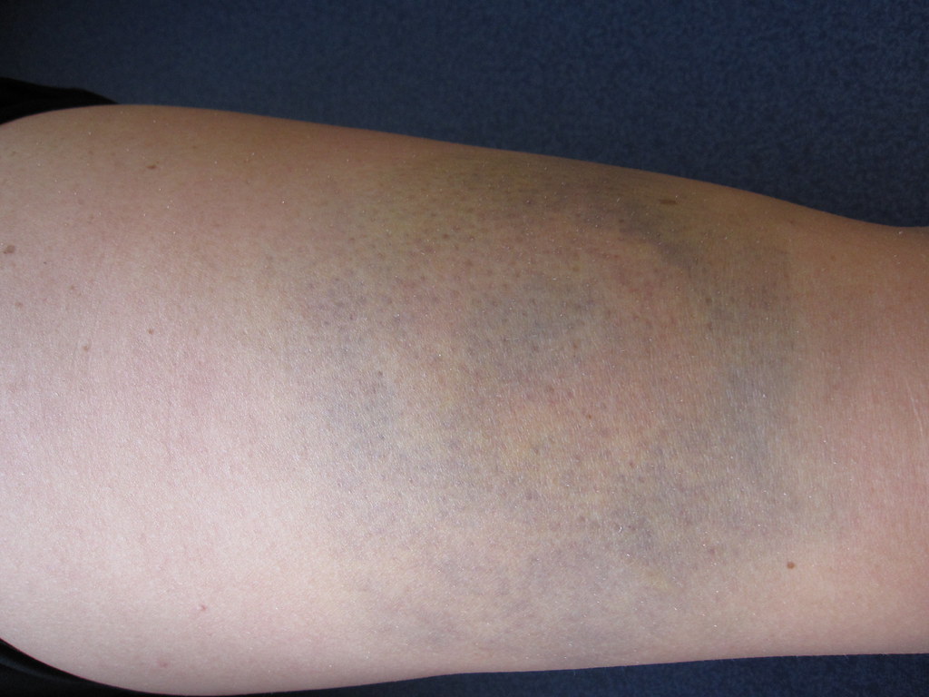 Quadriceps bruise before treatment