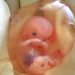 Fetus-removed-for-moms-health-reasons