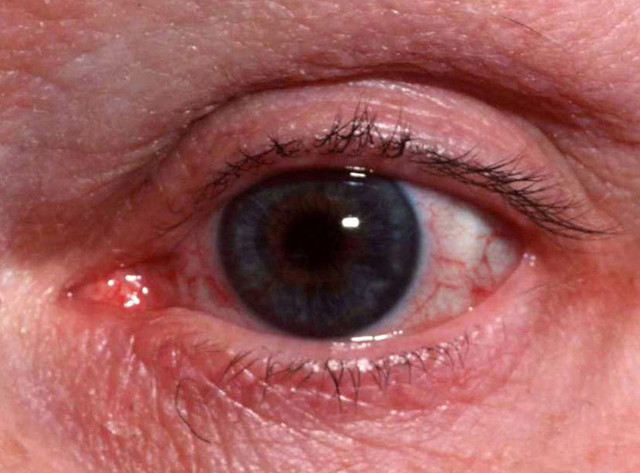 Ocular Rosacea Treatment & Management: Medical Care ...