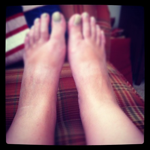 I quite literally have no ankles. They are gone. How much worse can they get in 3 months?  Ug!!!
