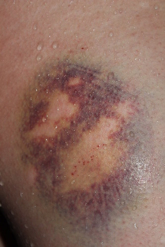 Mike's Bruise