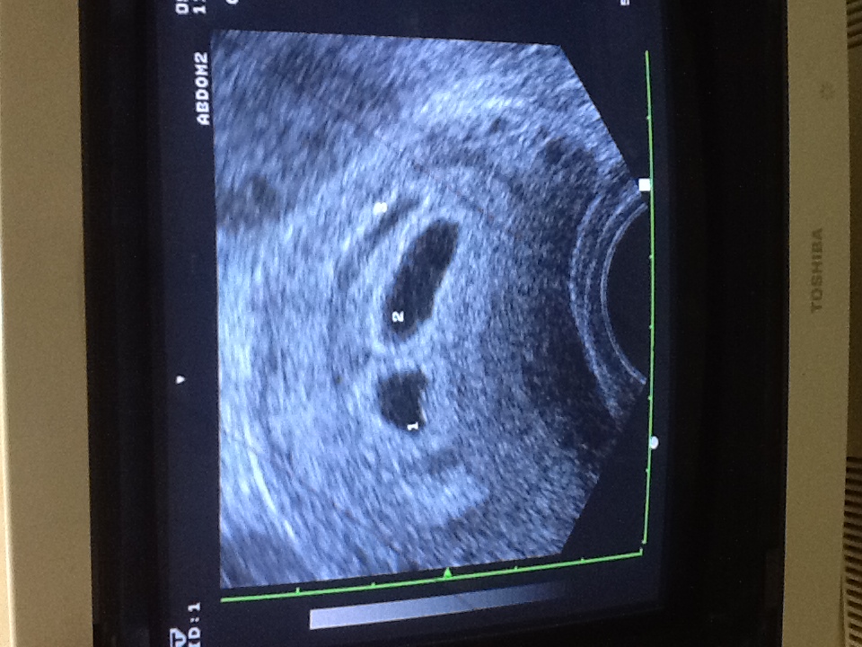 為求子奮鬥12年　夢見媽祖指示終懷3胞胎,蔡鋒博醫師評估她的AMH，居然是＜0.14！建議她要用〝積少成多（零存整付）〞的試管嬰兒，好像撲滿存錢。她也真的從3月到8月，在博元總共做了6次試管嬰兒取卵手術，包括2次沒取到卵子，總共累積了3個胚胎，8月11日一次植入子宮