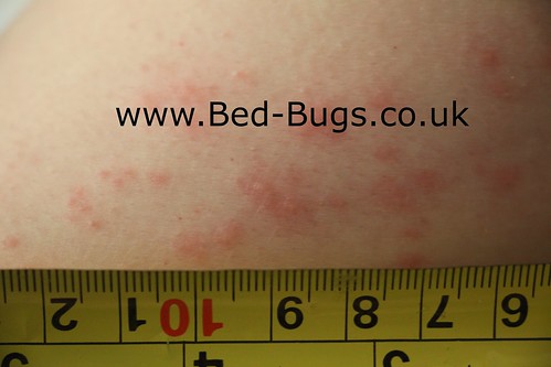 New Bite primer (my 5,000th post) Â« Got Bed Bugs? Bedbugger Forums