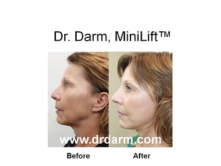 Dr. Darm MiniLift, Slide5