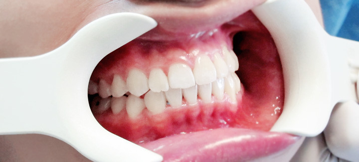 teeth after invisalign typicalben