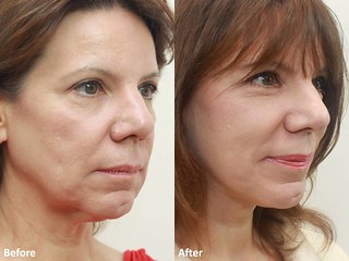 Dr Darm MiniLift Before and After - CC (6)