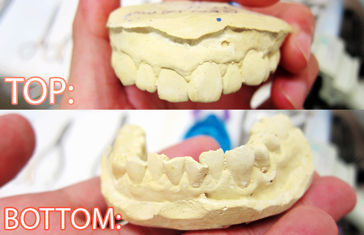 typicalben top and bottom teeth mold initially before invisalign