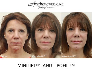 Dr. Darm, MiniLift and LipoFill Before and After - CCSlide1