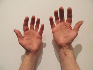 Bleeding hands
