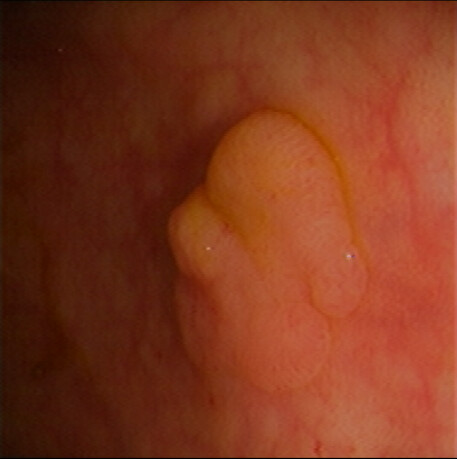 Colonic Polyp, Sessile