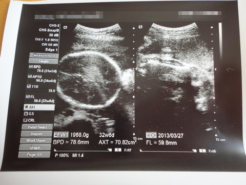 赤ちゃん エコー写真 妊娠8ヶ月 (さなさん)