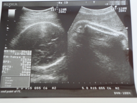 赤ちゃん エコー写真 妊娠8ヶ月 (さなさん)