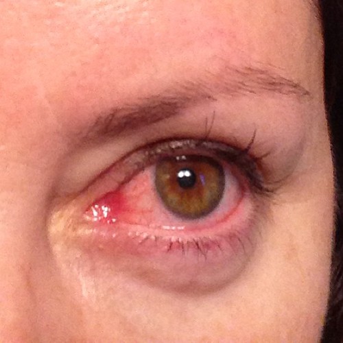 Seems the raging chest cold wasn't enough for my body this week ... I had to get pink eye too. FML