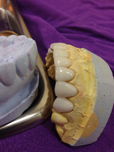 Dental Veneers (วีเนียร์ฟันขาว)
