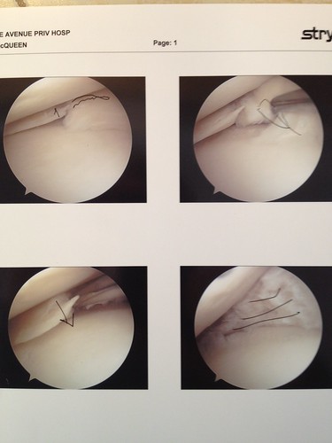 R Knee Arthrscope Aug 2012