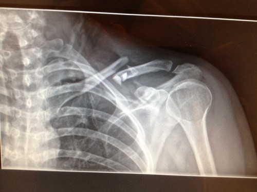 Shattered Collarbone