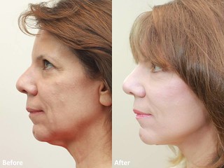 Dr Darm MiniLift Before and After - CC (5)