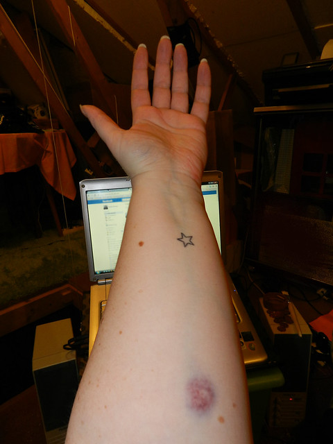 Mystery bruise!