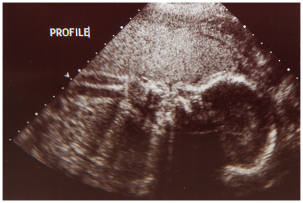 Baby's profile in utero at 26 weeks pregnant