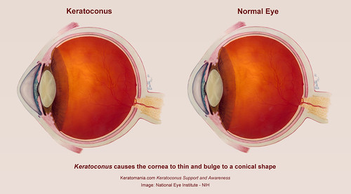 Keratoconus Eye Diagram by Keratomania, Based on an image from National Eye Institute NIH