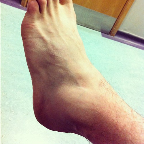 Swollen Ankle