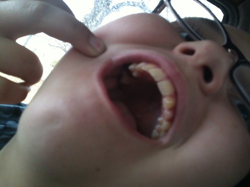 Emily Lost A Tooth! 12-3-2012