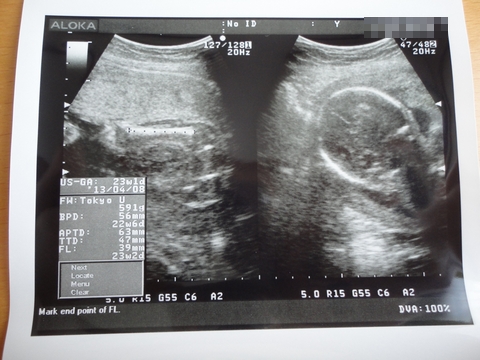 赤ちゃん エコー写真 妊娠6ヶ月 (さなさん)