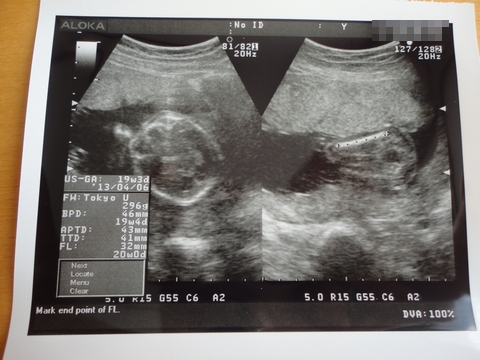 赤ちゃん エコー写真 妊娠5ヶ月 (さなさん)