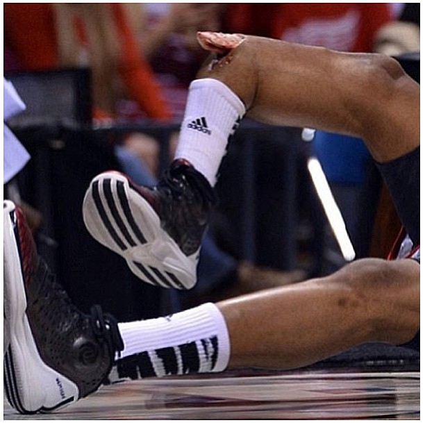 Sorry for Kevin Ware of Louisville with his bone breaking out of his flesh. #bone #broken # ...