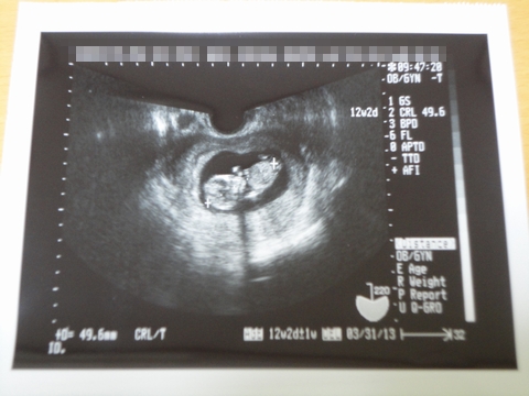 赤ちゃん エコー写真 妊娠3ヶ月 (さなさん)