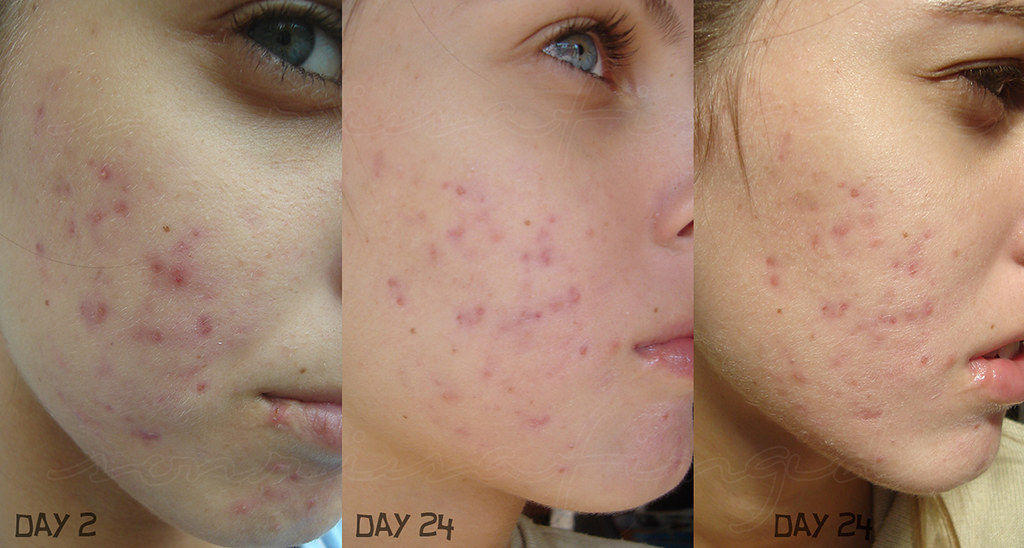 can you take doxycycline twice a day for acne