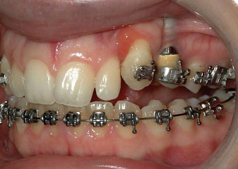 Dental Braces and Dental Implant