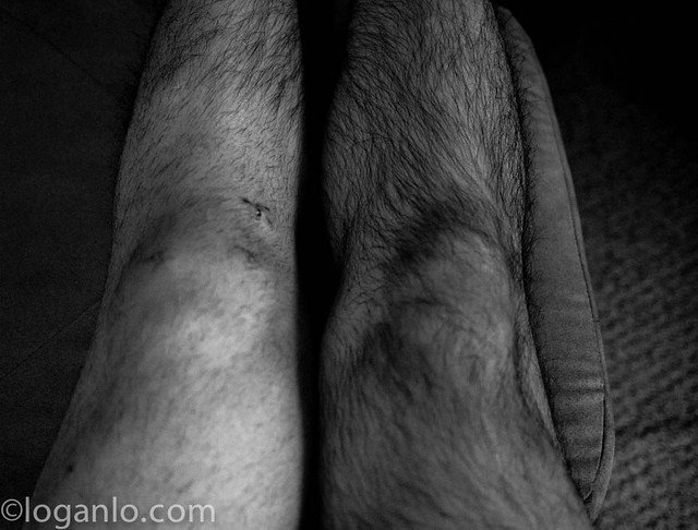 Knobby knees after ACL surgery