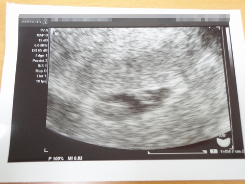 赤ちゃん エコー写真 妊娠2ヶ月 (さなさん)