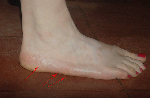 Soft Papules on the Heels - Medscape