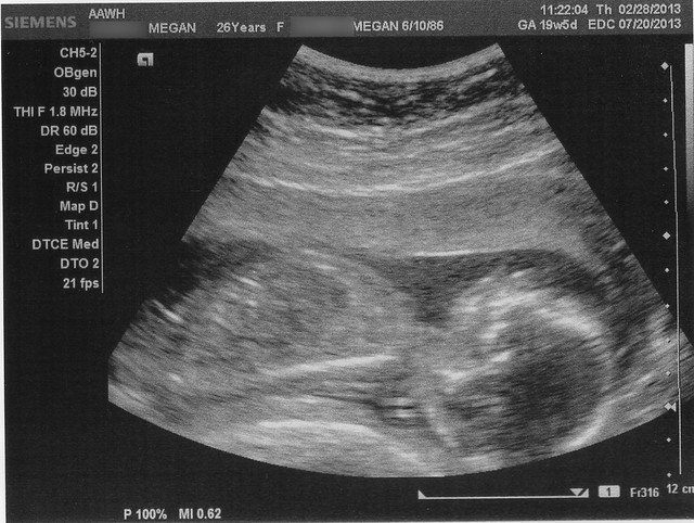 Ultrasound Pictures (19w5d)