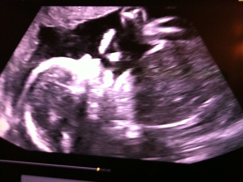And the little lady during 26 weeks moving about on camera.