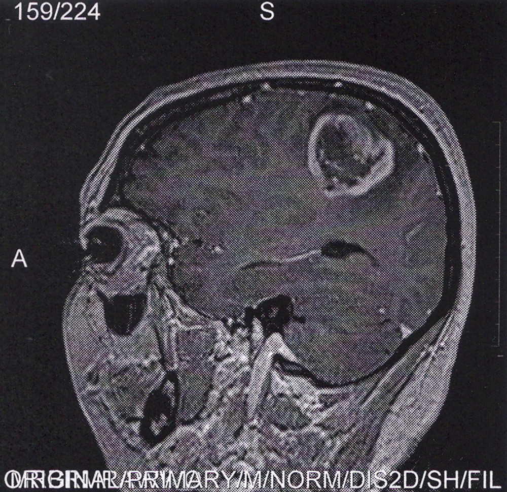 2012_0306_brain tumor 1