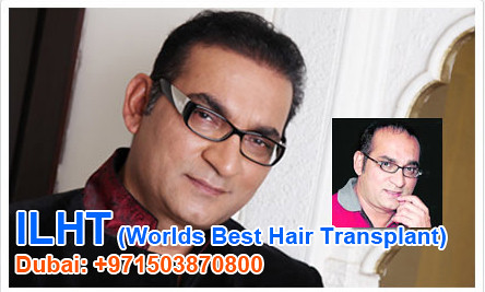 ABHI JEET Celebrity hair Transplant by aizaakhan