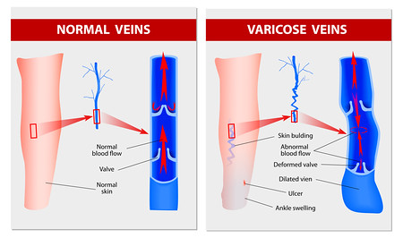 VARICOSE VEINS. Medical illustration